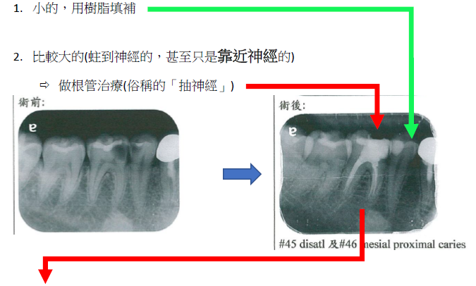 大蛀牙治療