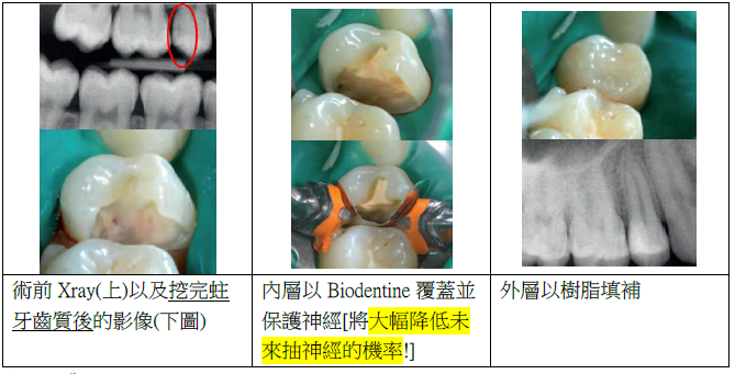 活髓治療案例